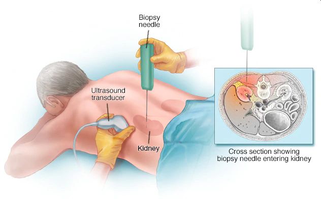 Kidney-Biopsy